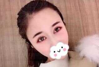 看了我找海南华美赵晓兰做的眼综合45天恢复效果后堂姐说准备也去做一个! 图2