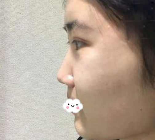 花1万多元找深圳整鼻子很有名的深圳阳光医院罗志敏医生为我做了膨体鼻综合隆鼻