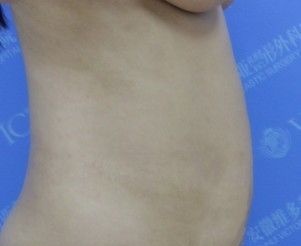 案例专享：苹果型身材找安徽徐和林做腰腹吸脂手术，术后50天恢复经历真实写照