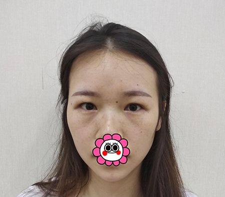 杭州维多利亚俞国宝为我做的开扇双眼皮得到了很多人的夸奖