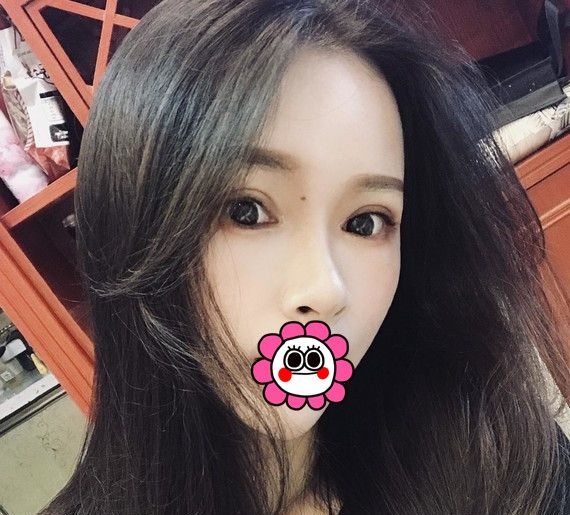 杭州维多利亚俞国宝为我做的开扇双眼皮得到了很多人的夸奖 图2