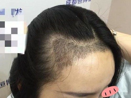 秃头妹来成都恒博植发做完M型发际线移植后各种发型都可轻松驾驭 图2