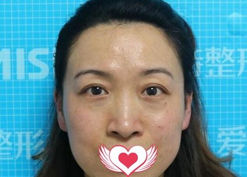 南宁爱思特做自体脂肪填充就是好,终于不再是老阿姨了!