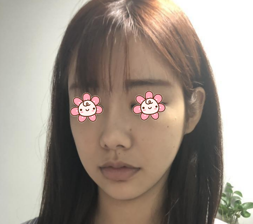 深圳南雅整形厚唇改薄术后7天恢复过程全纪录
