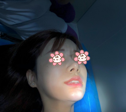深圳南雅整形厚唇改薄术后7天恢复过程全纪录 图2