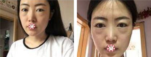 蛮巧合的去了贵阳利美康做内切祛眼袋,肿胀挺小的,顺便也堵堵家人催婚的嘴!