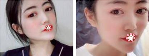 蛮巧合的去了贵阳利美康做内切祛眼袋,肿胀挺小的,顺便也堵堵家人催婚的嘴! 图2