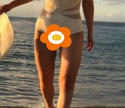 到泉州做大腿吸脂满三个月,今天来聊聊我的心路历程