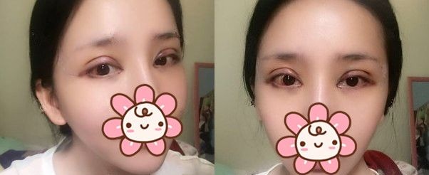 前段时间刚在泰州丽都做完眼部综合的我来说说恢复那些事儿