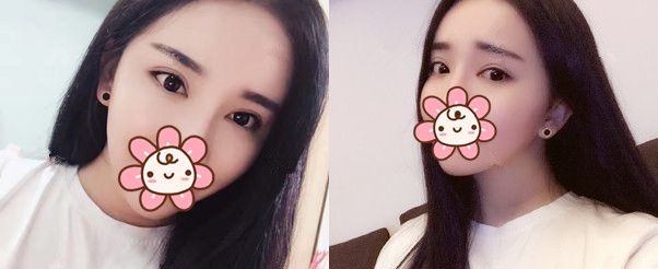 前段时间刚在泰州丽都做完眼部综合的我来说说恢复那些事儿 图2