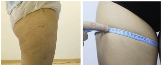 这次去深圳富华医院做大腿抽脂花了4万多元,就吸脂效果来看性价比还是蛮高的