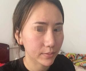 全麻做的自体脂肪面部填充全脸到今天一个月了