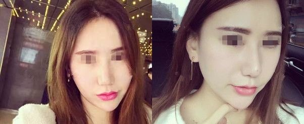 全麻做的自体脂肪面部填充全脸到今天一个月了 图2