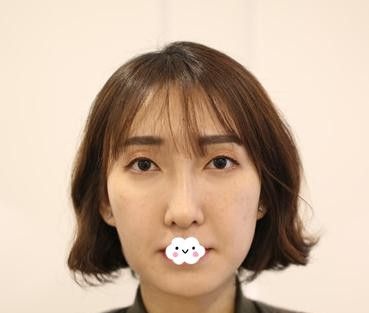 我比较青睐可吸收线才选择武汉卓美做了大V线全脸埋线提升