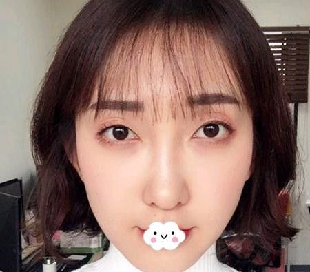 我比较青睐可吸收线才选择武汉卓美做了大V线全脸埋线提升 图2