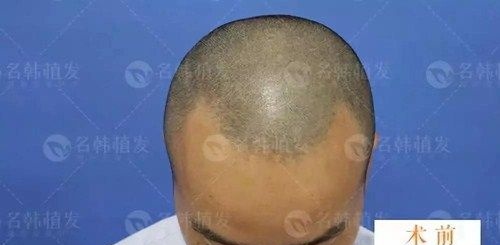 我今年30岁因额角大来济南名韩植发做的前额发际线种植,现在是术后4个月