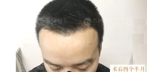 我今年30岁因额角大来济南名韩植发做的前额发际线种植,现在是术后4个月 图2
