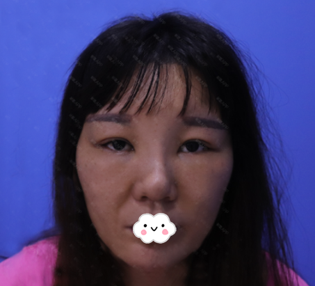 参考朋友的隆鼻效果我也花两万多元去广州找邓正军做了鼻子