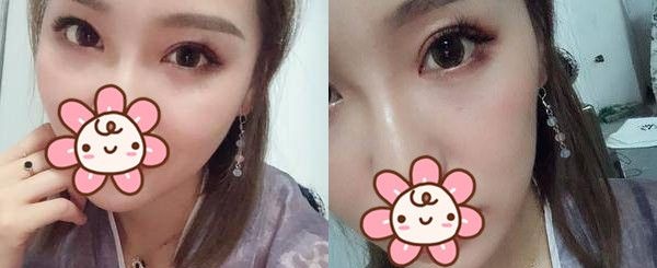 两千到两万不等的双眼皮,在南京华美做了才知道价格相差在眼综合项目 图2