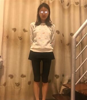 我在重庆美莱做大腿抽脂感受很深的一点就是没有凹凸不平,然后一般的疼 图2