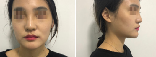 西安画美整形医院做假体隆鼻手术真的厉害,看我恢复以后的照片就知道了