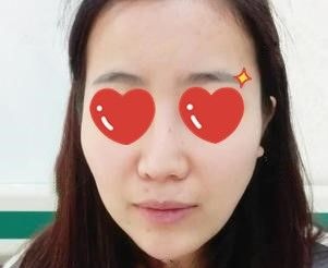 额头凹陷选太原军大做脂肪填充面部的恢复期确实很难熬,但效果挺不错