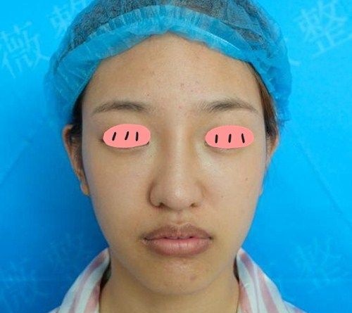 我天生塌鼻梁,自从找商丘冰薇张帅兵做膨体隆鼻后不再害怕隆鼻后遗症