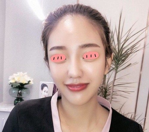 我天生塌鼻梁,自从找商丘冰薇张帅兵做膨体隆鼻后不再害怕隆鼻后遗症 图2