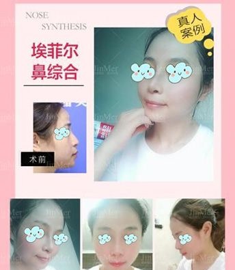 征集到三例铜陵晶美整形案例,看硅胶假体+自体软骨隆鼻的真实恢复过程