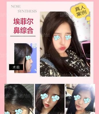 征集到三例铜陵晶美整形案例,看硅胶假体+自体软骨隆鼻的真实恢复过程 图2