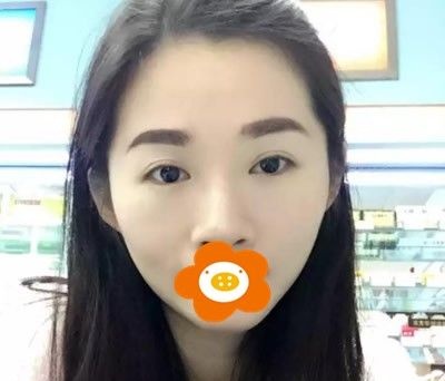 更新我在厦门华美做自体脂肪填充全脸恢复2个月的手术案例图