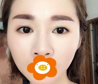更新我在厦门华美做自体脂肪填充全脸恢复2个月的手术案例图 图2