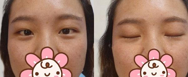埋线一个月变内双，没办法只好到连云港华美拆了线重新做了切开双眼皮