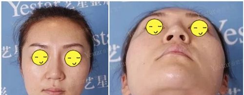 假体隆鼻失败歪斜在合肥艺星做肋软骨鼻综合修复过程