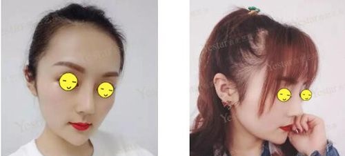 假体隆鼻失败歪斜在合肥艺星做肋软骨鼻综合修复过程 案例图2