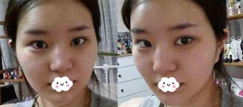 我找武汉卓美吴秀英做耳软骨复合隆鼻价格比自体肋软骨隆鼻费用低不少呢!