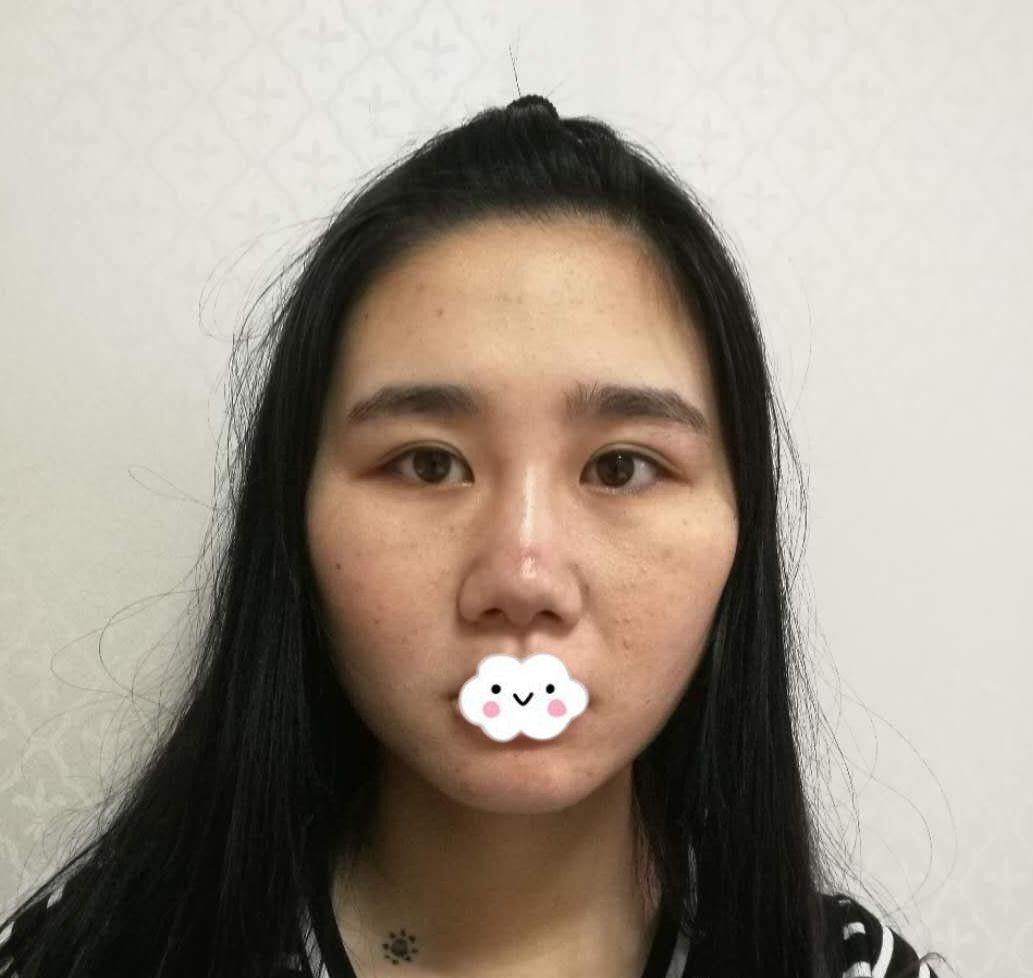 担心脂肪玻尿酸吸收率问题所以不后悔在武汉卓美做了硅胶假体垫下巴