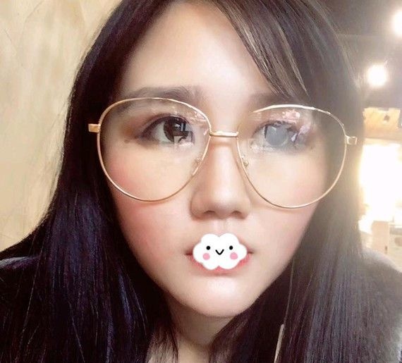 担心脂肪玻尿酸吸收率问题所以不后悔在武汉卓美做了硅胶假体垫下巴 图2