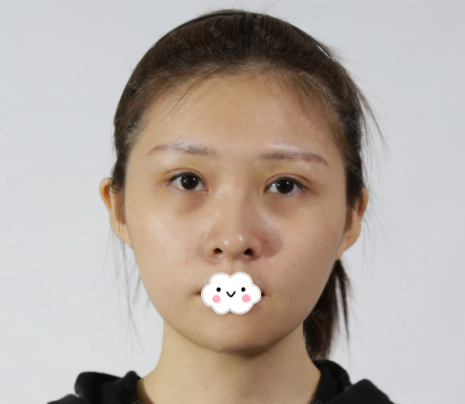 今天得空给大家看下我花6800多元找广州曙光张小芸做的三分钟去眼袋效果有多好