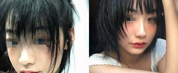 知道微笑唇可能留疤后选南京韩辰做了M唇,术后三个月麻木感才消失 图2
