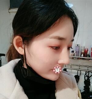 半年前我在重庆联合丽格割双眼皮没留疤,现在来做驼峰鼻矫正,没肿得像猪头 图2
