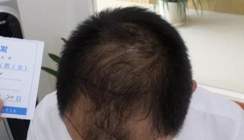 宋先生脱发6年从小伙变大叔!长沙岱高做头顶加密植发5小时后有了不一样的变化
