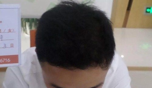 宋先生脱发6年从小伙变大叔!长沙岱高做头顶加密植发5小时后有了不一样的变化 图2