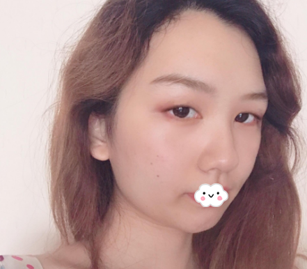查询医疗资质发现广州荔医整形是正规靠谱的医院后花1万多元做了全切双眼皮