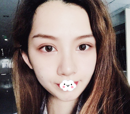查询医疗资质发现广州荔医整形是正规靠谱的医院后花1万多元做了全切双眼皮 案例图2