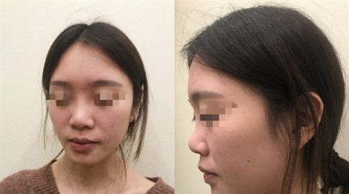 在信阳东方艺做鼻综合手术四个月再也不用担心被人说鼻子很假