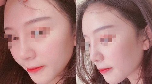 在信阳东方艺做鼻综合手术四个月再也不用担心被人说鼻子很假 图2
