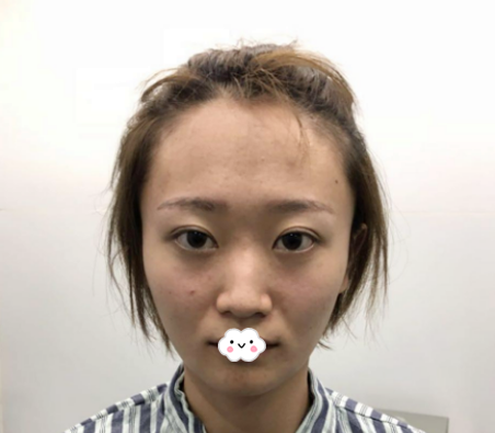 鼻子塌鼻头大别担心,可以通过做假体隆鼻和自体耳软骨垫鼻尖来让鼻子变高变挺哦