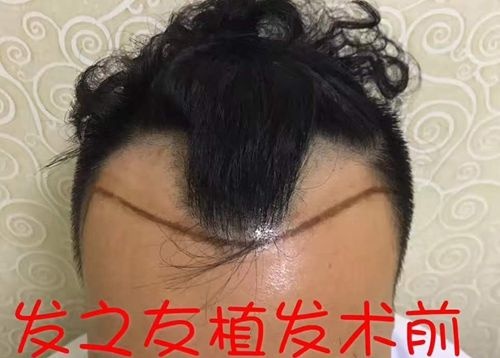 我前额雄性脱发有幸通过FD-FUE植发技术躲过了“中年危机”