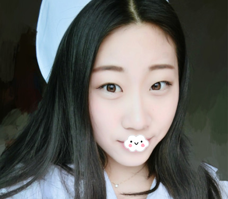 欢迎大家来看我的全切双眼皮恢复记录,进来感受下宛如天生的双眼皮长什么样